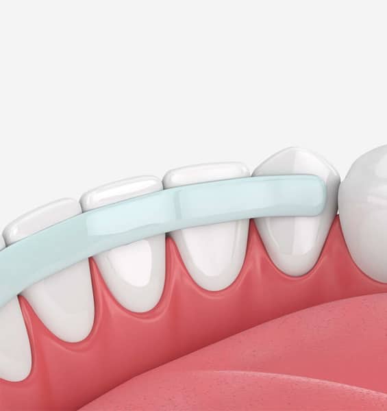 Bonding and White Fillings in Toms River, NJ - North Dover Dental