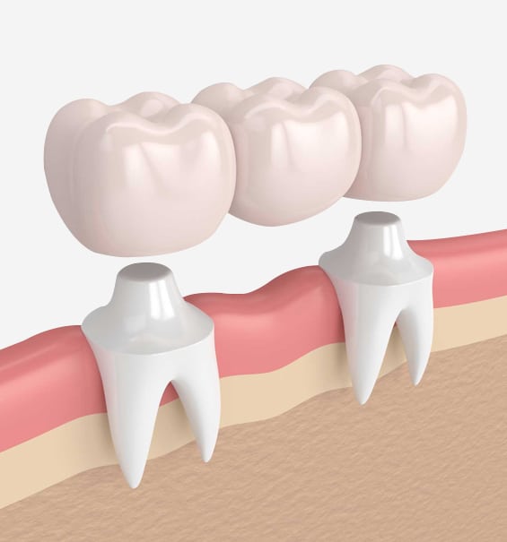 Bridges in Toms River, NJ - North Dover Dental