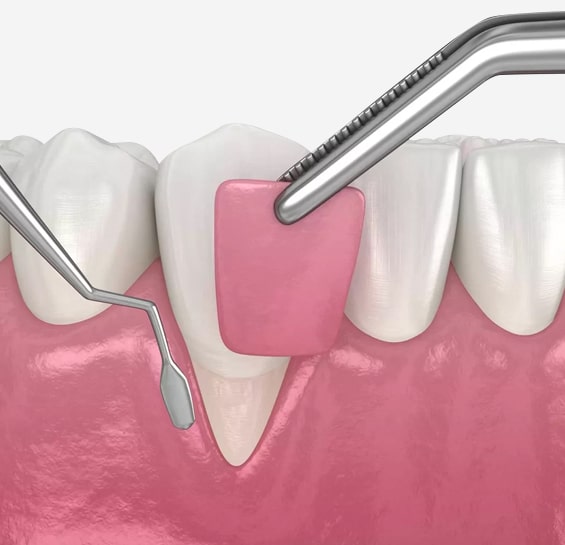 Crown Lengthening in Toms River, NJ - North Dover Dental