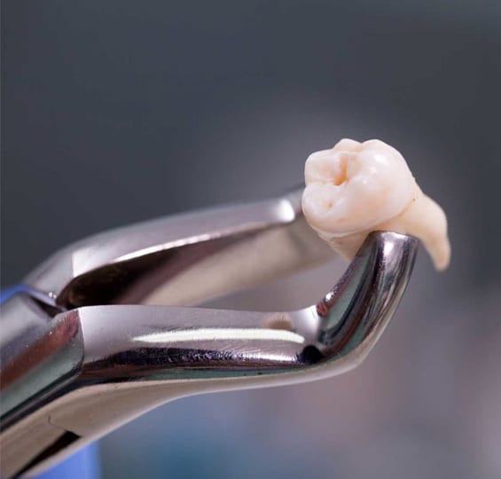 Tooth Extractions in Toms River, NJ - North Dover Dental
