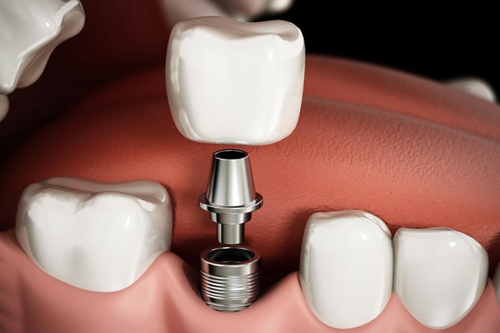 Dental Implants in Toms River, NJ - North Dover Dental