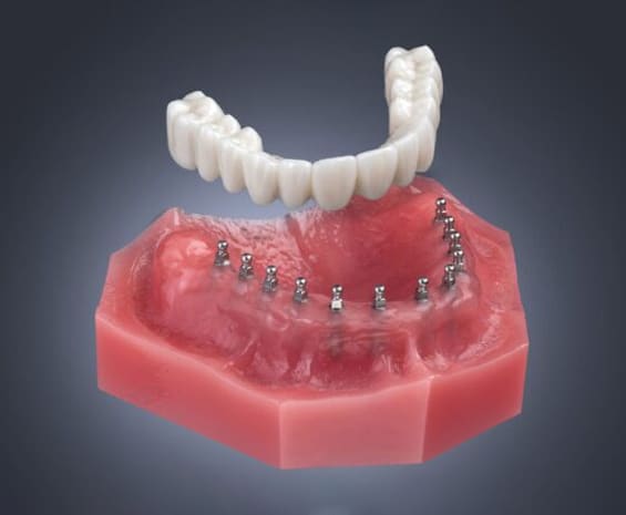Mini Implants in Toms River, NJ - North Dover Dental