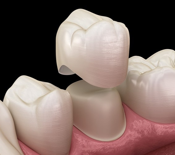 Same-day Crowns in Toms River, NJ - North Dover Dental