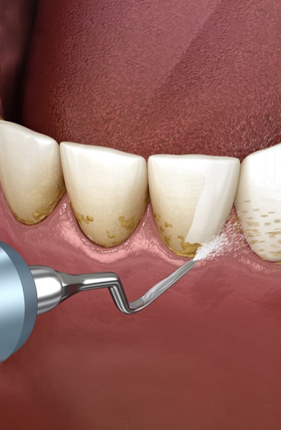 Scaling and Root Planing in Toms River, NJ - North Dover Dental