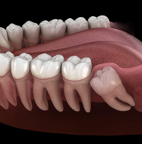 Wisdom Teeth Removal in Toms River, NJ - North Dover Dental