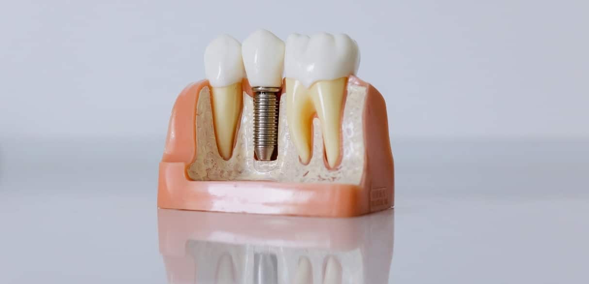 professional tips for caring for your dental implants to get long-lasting results