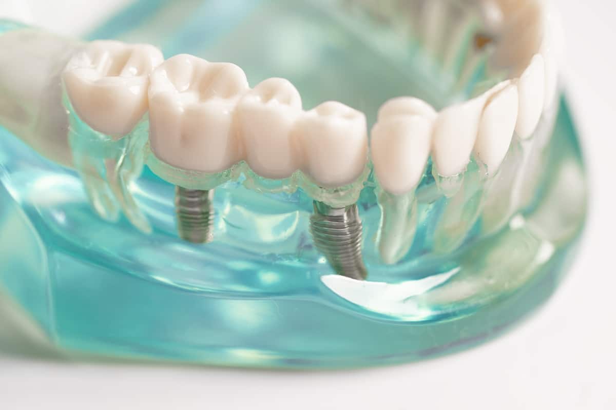 are dental implants worth it