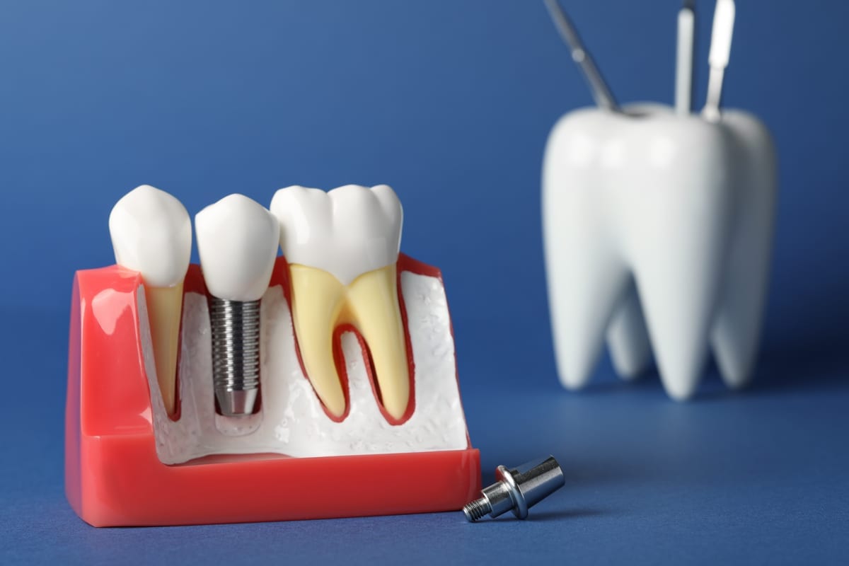 Dental Implants in Toms River